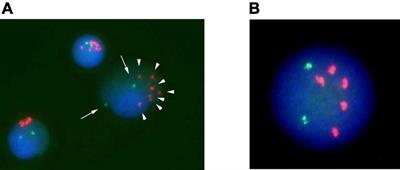 Successful hematopoietic stem cell transplantation for two patients with relapse of intrachromosomal amplification of chromosome 21-positive B-cell precursor acute lymphoblastic leukemia